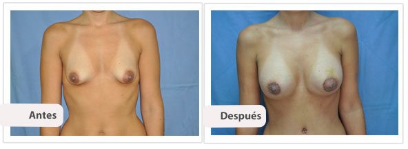 Caso 8 TAMAÑO: 325 cc