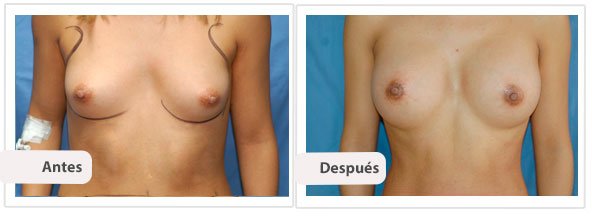 Caso 9 TAMAÑO: 350 cc