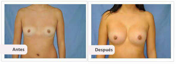 Caso 4 TAMAÑO: 300 cc