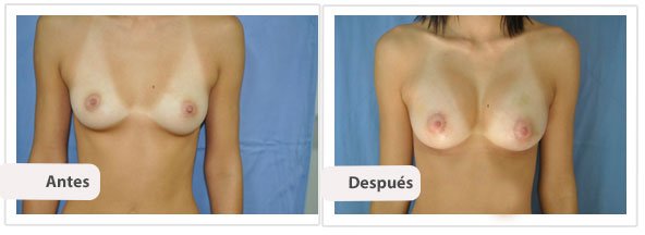 Caso 5 TAMAÑO: 300 cc