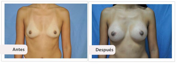 Caso 3 TAMAÑO: 275 cc