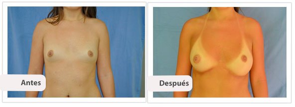 Caso 6 TAMAÑO: 300 cc