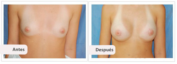 Caso 1 TAMAÑO: 300 cc