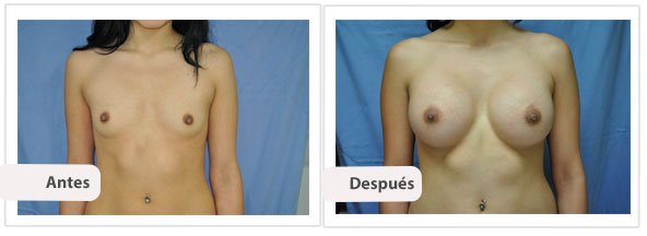 Caso 11 TAMAÑO: 500 cc