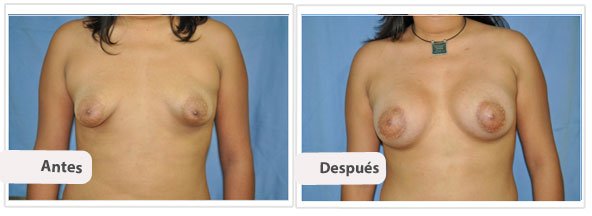 Caso 8 TAMAÑO: 350 cc