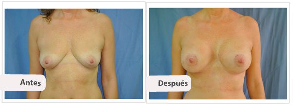 Caso 12 TAMAÑO: 500 cc