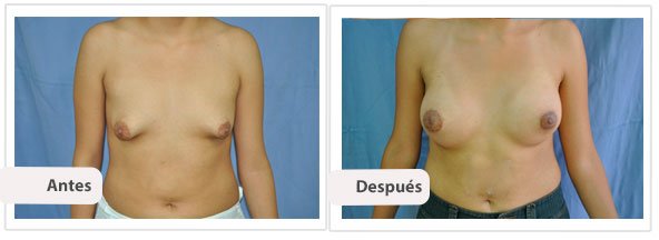 Caso 2 TAMAÑO: 300 cc