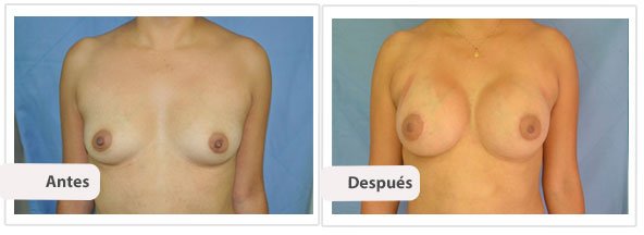 Caso 3 TAMAÑO: 300 cc