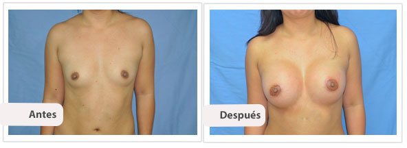 Caso 4 TAMAÑO: 350 cc