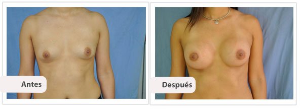 Caso 5 TAMAÑO: 350 cc