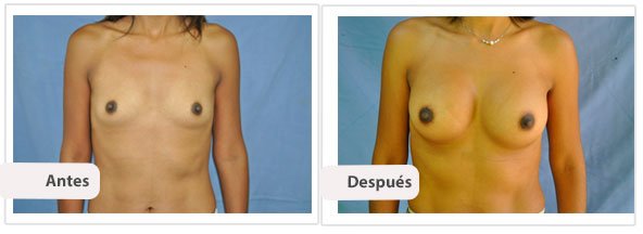 Caso 6 TAMAÑO: 350 cc