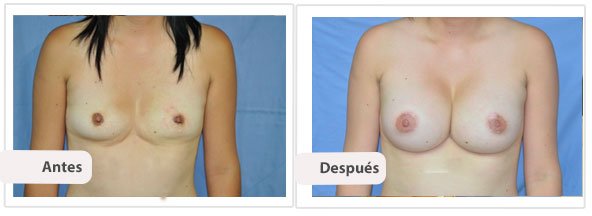 Caso 7 TAMAÑO: 450 cc