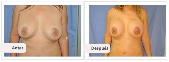 Caso 9 TAMAÑO: 500 cc