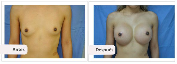 Caso 10 TAMAÑO: 500 cc