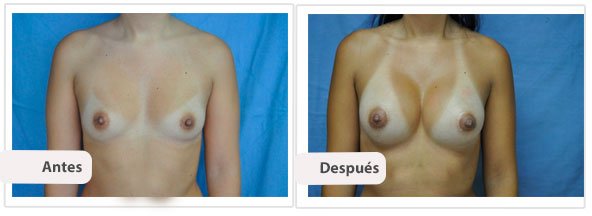 Caso 1 TAMAÑO: 225 cc