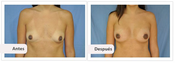 Caso 10 TAMAÑO: 325 cc