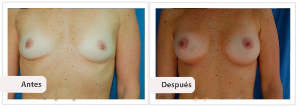 Caso 11 TAMAÑO: 325 cc