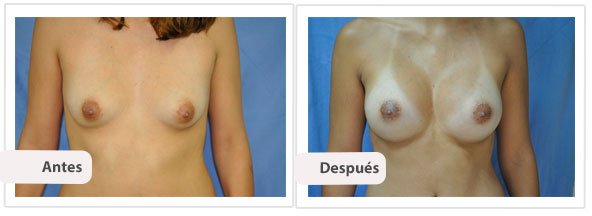 Caso 13 TAMAÑO: 350 cc