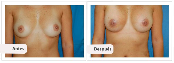 Caso 14 TAMAÑO: 350 cc