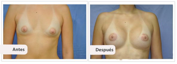 Caso 3 TAMAÑO: 250 cc