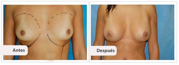 Caso 8 TAMAÑO: 300 cc