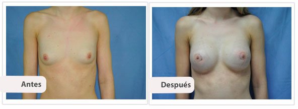 Caso 4 TAMAÑO: 275 cc