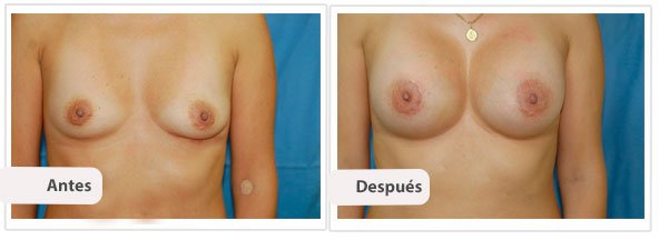 Caso 6 TAMAÑO: 300 cc