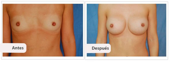 Caso 9 TAMAÑO: 325 cc