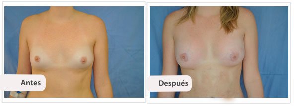 Caso 5 TAMAÑO: 275 cc