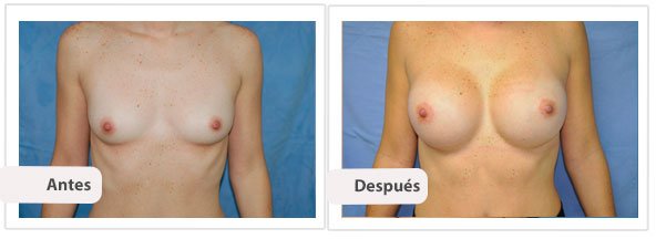 Caso 12 TAMAÑO: 325 cc