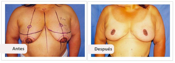 Mamoplastía sin Cicatriz Vertical: Caso 3
