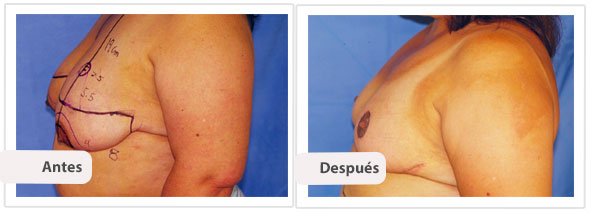 Mamoplastía sin Cicatriz Vertical: Caso 3