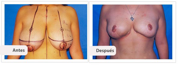 Mamoplastía sin Cicatriz Vertical: Caso 4