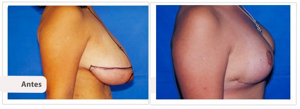 Mamoplastía sin Cicatriz Vertical: Perfil Caso 4