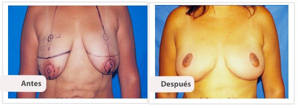 Mamoplastía sin Cicatriz Vertical: Caso 5