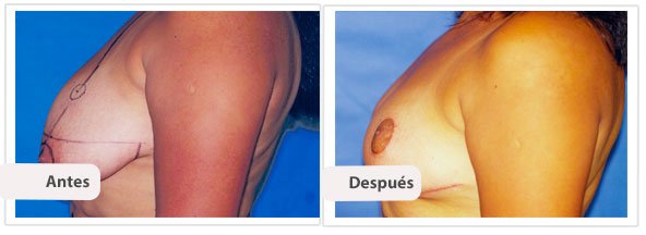 Mamoplastía sin Cicatriz Vertical: Perfil Caso 5