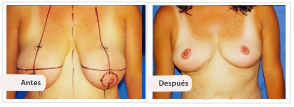 Mamoplastía sin Cicatriz Vertical: Caso 6