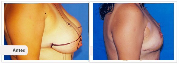 Mamoplastía sin Cicatriz Vertical: Perfil Caso 6