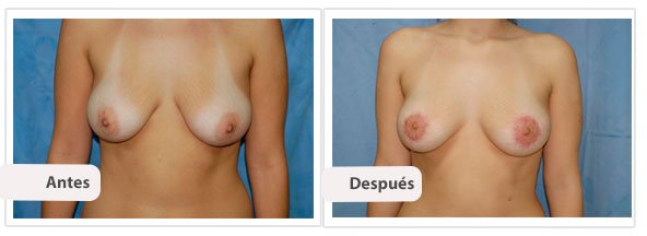 Mastopexia Peri Areolar: Caso 1