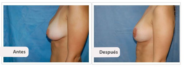 Mastopexia Peri Areolar: Perfil Caso 1