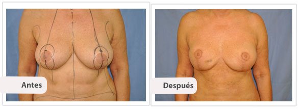 Mastopexia con Cicatriz T Corta: Caso 1