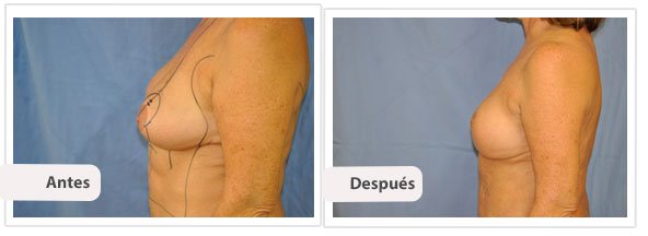 Mastopexia con Cicatriz T Corta: Perfil Caso 1
