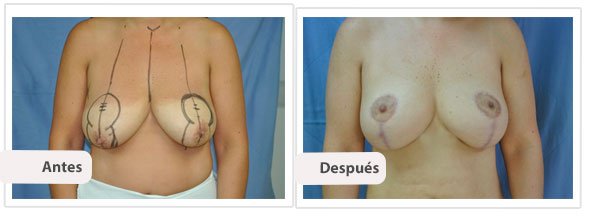 Mamoplastía Reductiva con Cicatriz T Corta: Caso 2
