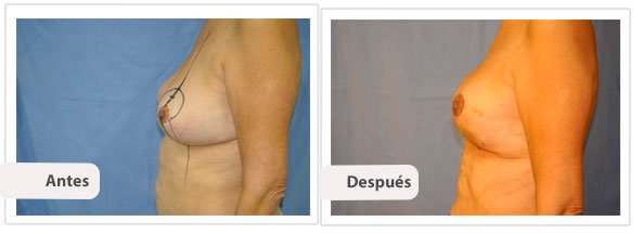 Mastopexia con Cicatriz T Corta: Perfil Caso 3