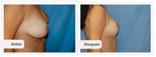 Mastopexia con Cicatriz T Corta: Perfil caso 4