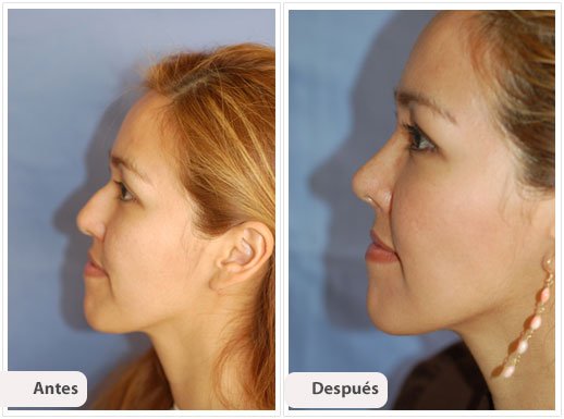 Rinoplastía Primaria: Perfil Caso 1