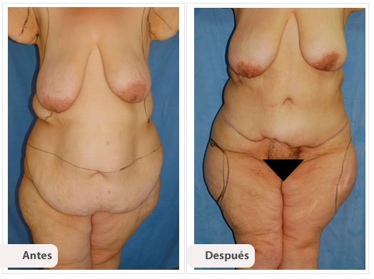 Cirugía Post Bariátrica: Caso 1