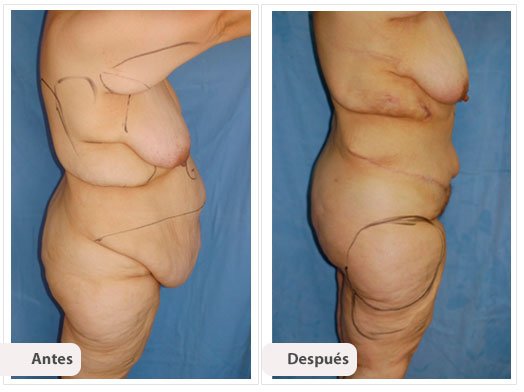 Cirugía Post Bariátrica: Perfil Caso 1