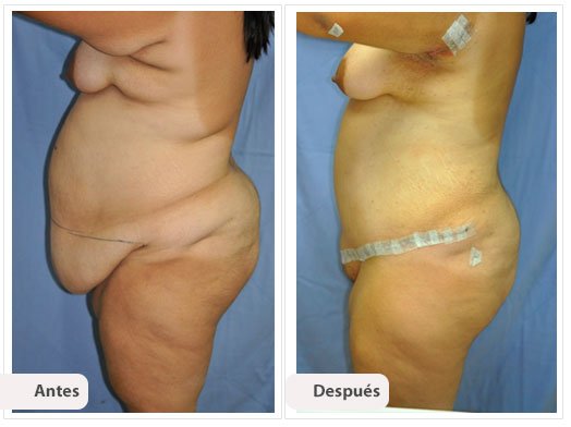 Cirugía Post Bariátrica: Perfil Caso 2