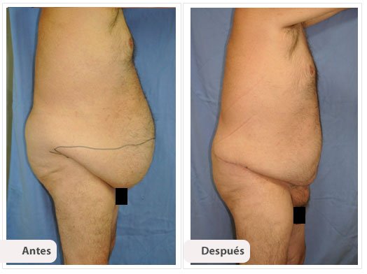 Cirugía Post Bariátrica: Perfil Caso 3